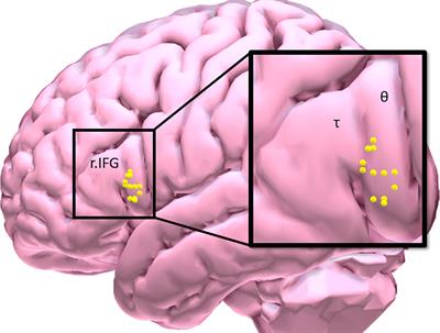 Dissociable Effects of Theta-Burst Repeated Transcranial Magnetic Stimulation to the Inferior Frontal Gyrus on Inhibitory Control in Nicotine Addiction